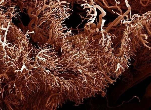 Scanning Electron Micrograph (SEM): a corrosion cast of a gut tumour. Liquid plastic is injected into the blood vessels; it solidifies and the tissues are dissolved away leaving a cast of the blood supply