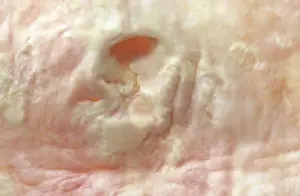 Disease Prints: Picture No. 10875838