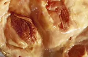 Disease Prints: Picture No. 10875842