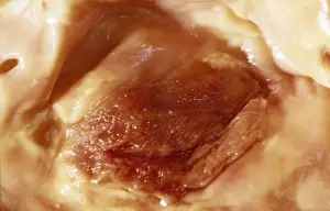 Disease Prints: Picture No. 10875844